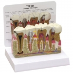 Human Teeth Model - Dental Problems