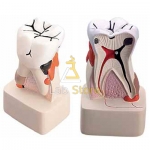 Dental Pathology Model