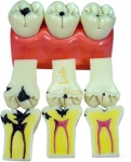 Dental Caries Model